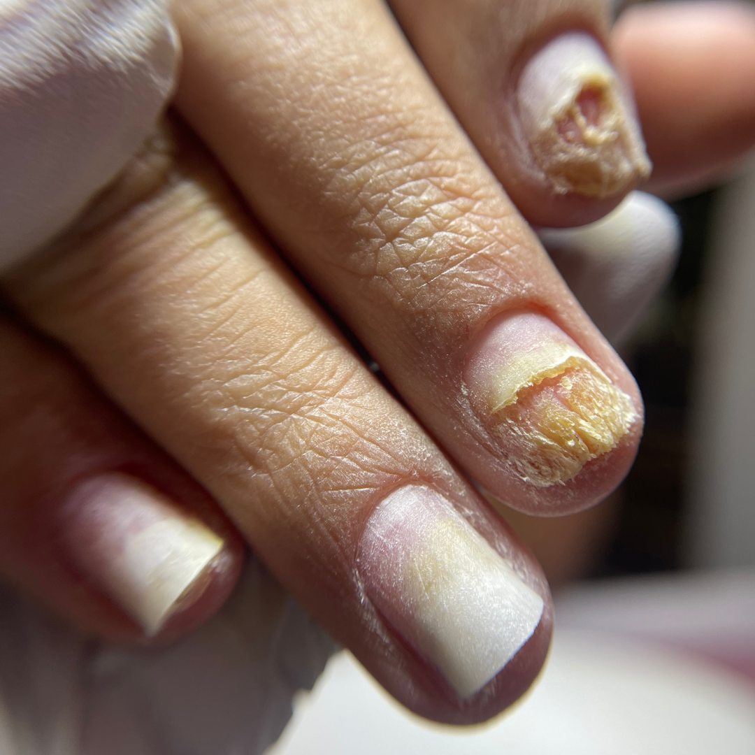 AntiFungus Nail Oil Treatment