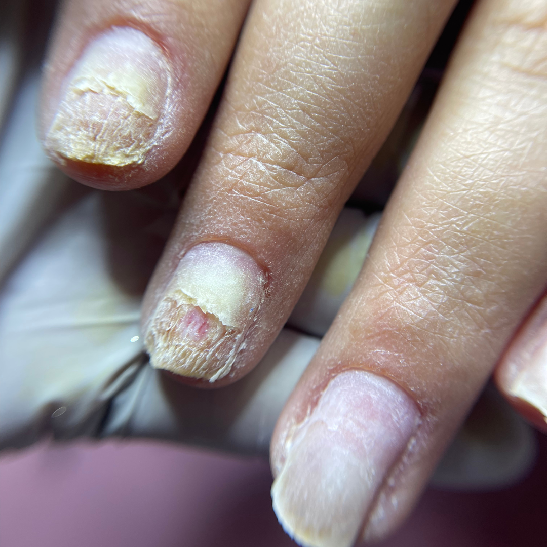 AntiFungus Nail Oil Treatment